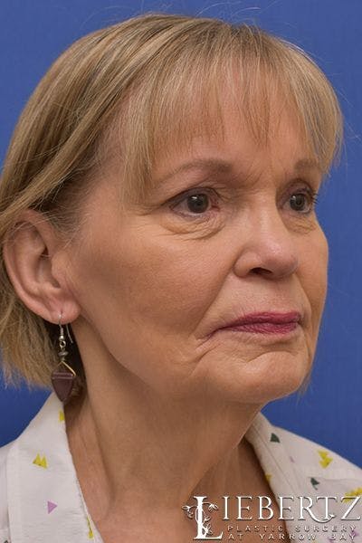 Necklift Before & After Gallery - Patient 877316 - Image 1