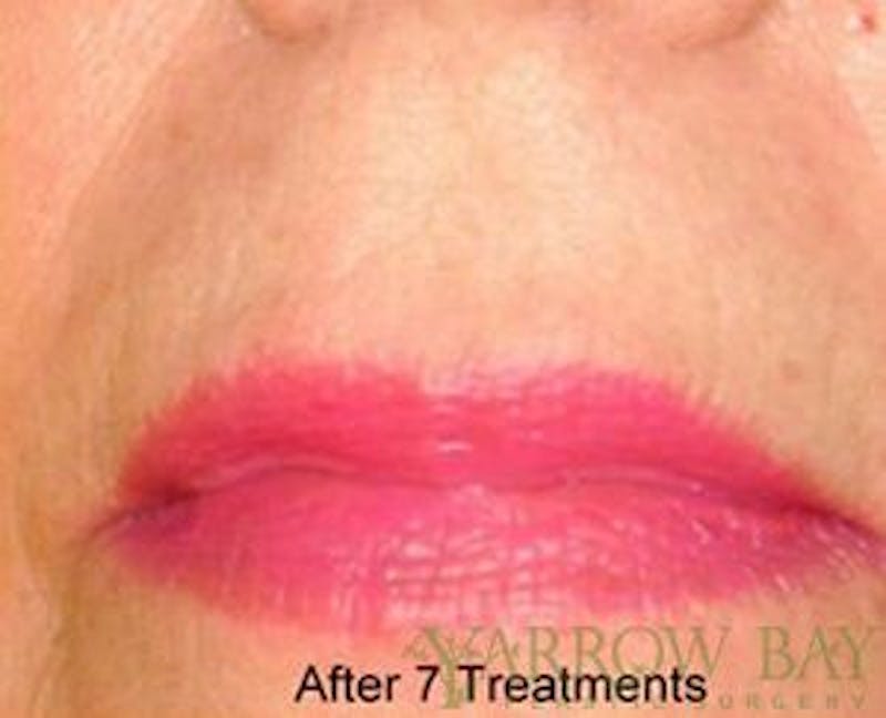 IPL & Laser Treatments Before & After Gallery - Patient 186175 - Image 2