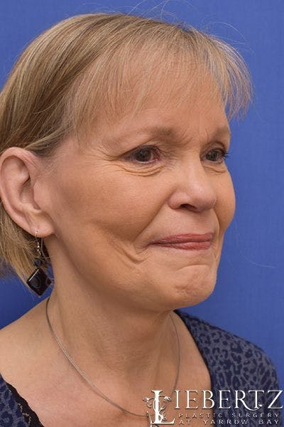 Necklift Before & After Gallery - Patient 877316 - Image 2