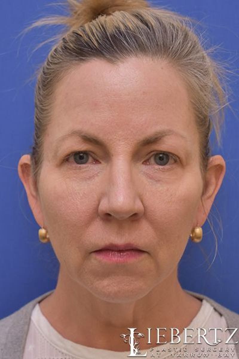 Necklift Before & After Gallery - Patient 206705 - Image 1