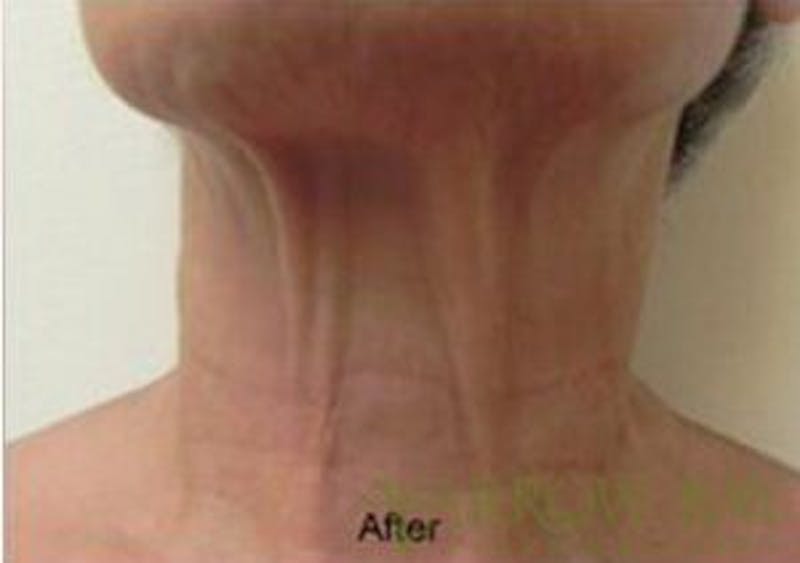 IPL & Laser Treatments Before & After Gallery - Patient 371022 - Image 2