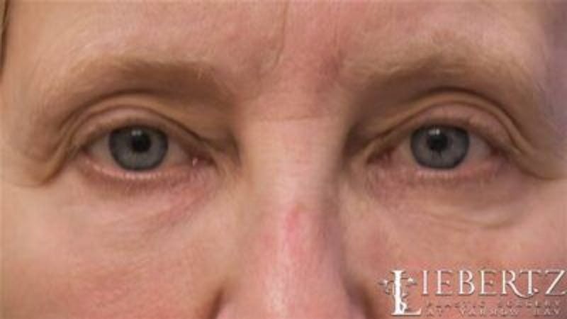 Blepharoplasty Before & After Gallery - Patient 263275 - Image 1