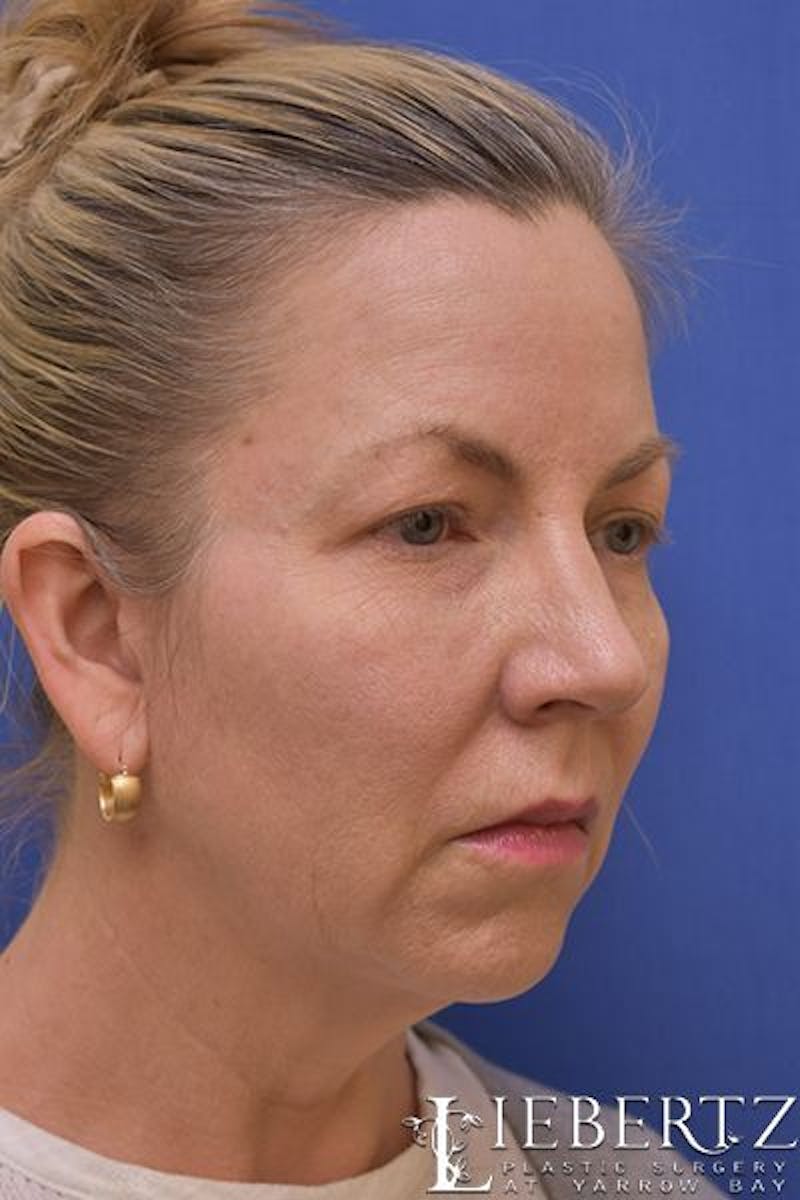 Necklift Before & After Gallery - Patient 206705 - Image 3