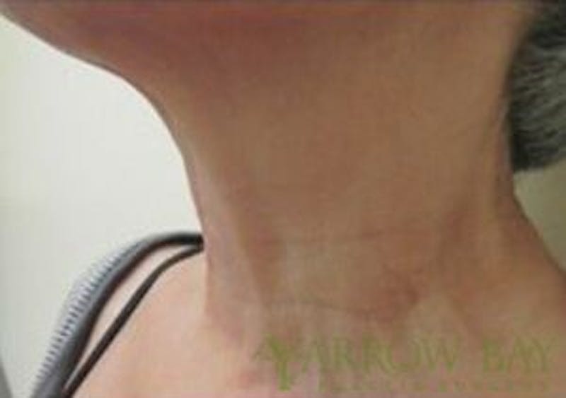 IPL & Laser Treatments Before & After Gallery - Patient 371022 - Image 4