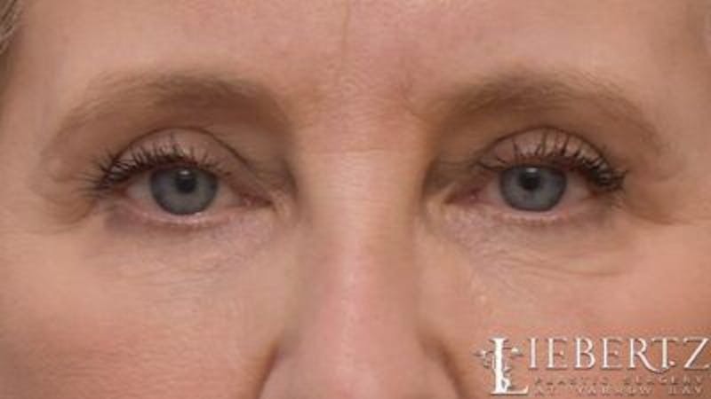 Blepharoplasty Before & After Gallery - Patient 263275 - Image 2