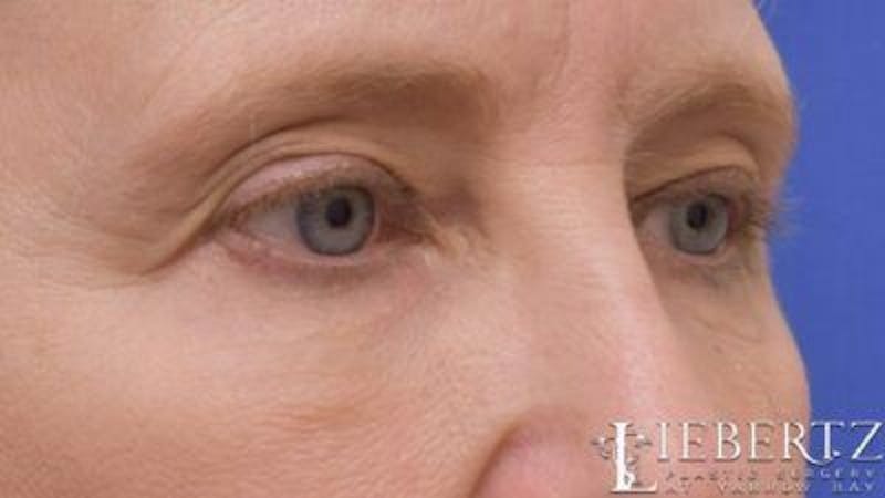 Blepharoplasty Before & After Gallery - Patient 263275 - Image 3