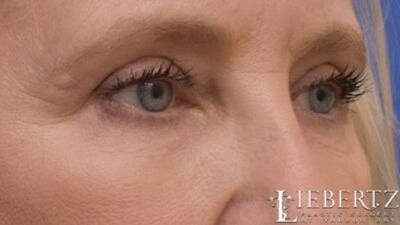 Blepharoplasty Before & After Gallery - Patient 263275 - Image 4