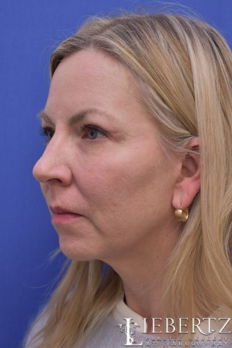 Necklift Before & After Gallery - Patient 206705 - Image 6