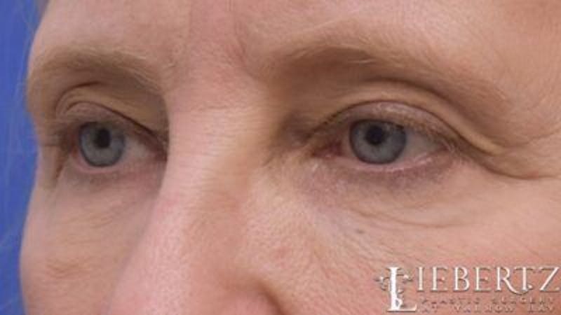 Blepharoplasty Before & After Gallery - Patient 263275 - Image 5