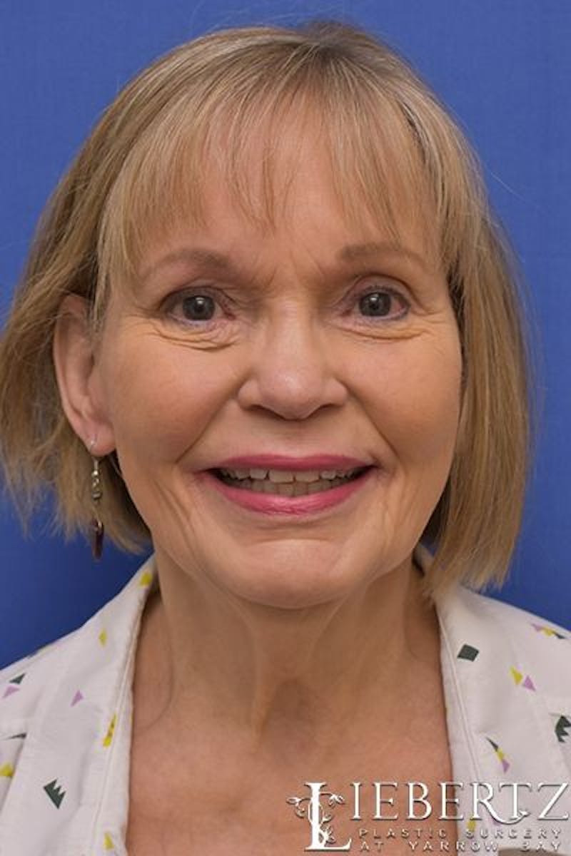 Facelift Before & After Gallery - Patient 411692 - Image 1