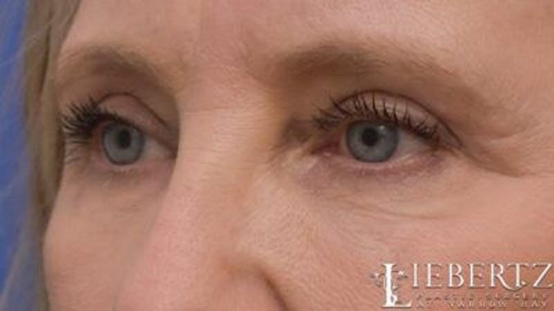 Blepharoplasty Before & After Gallery - Patient 263275 - Image 6