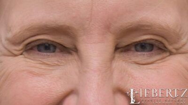 Blepharoplasty Before & After Gallery - Patient 263275 - Image 7