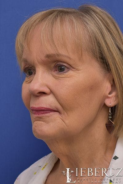 Facelift Before & After Gallery - Patient 411692 - Image 1