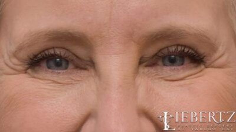 Blepharoplasty Before & After Gallery - Patient 263275 - Image 8