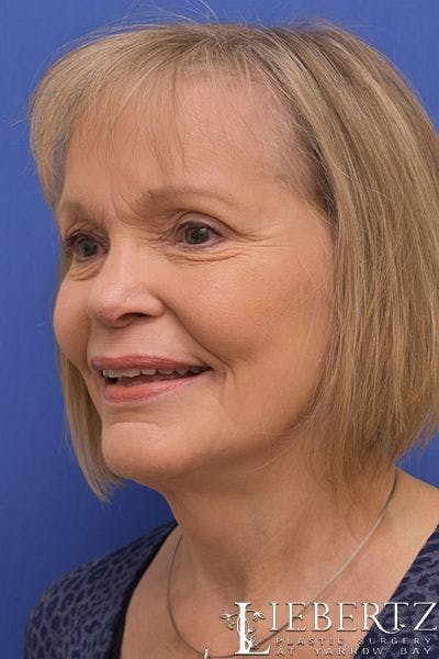 Facelift Before & After Gallery - Patient 411692 - Image 2