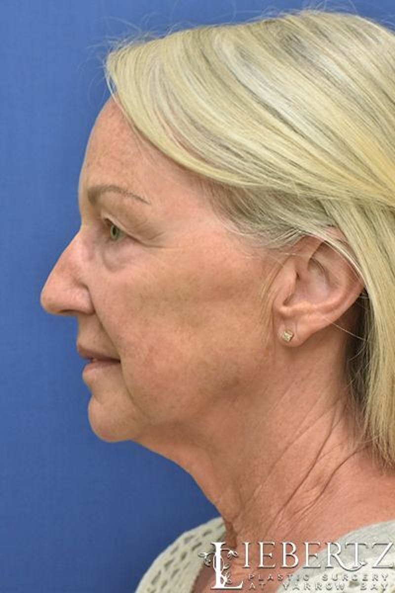 Necklift Before & After Gallery - Patient 344897 - Image 5