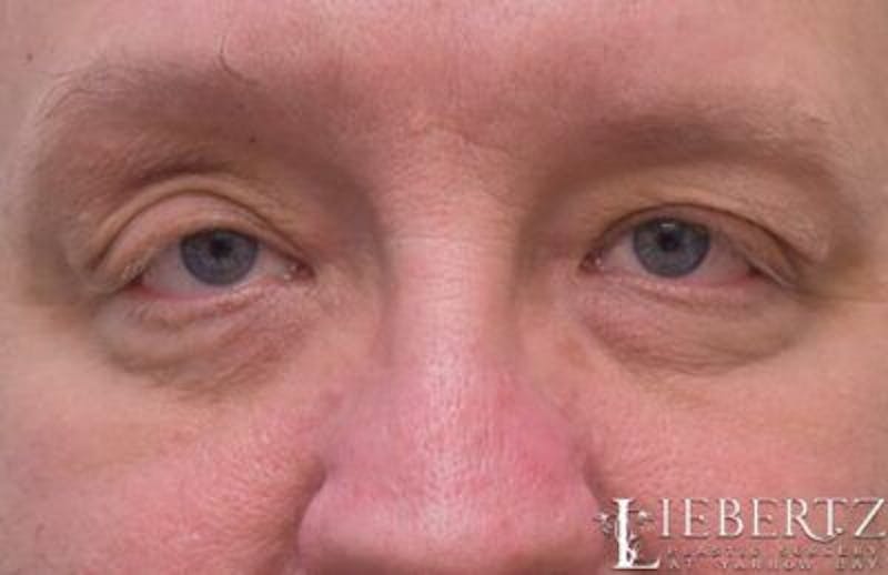 Blepharoplasty Before & After Gallery - Patient 411816 - Image 1