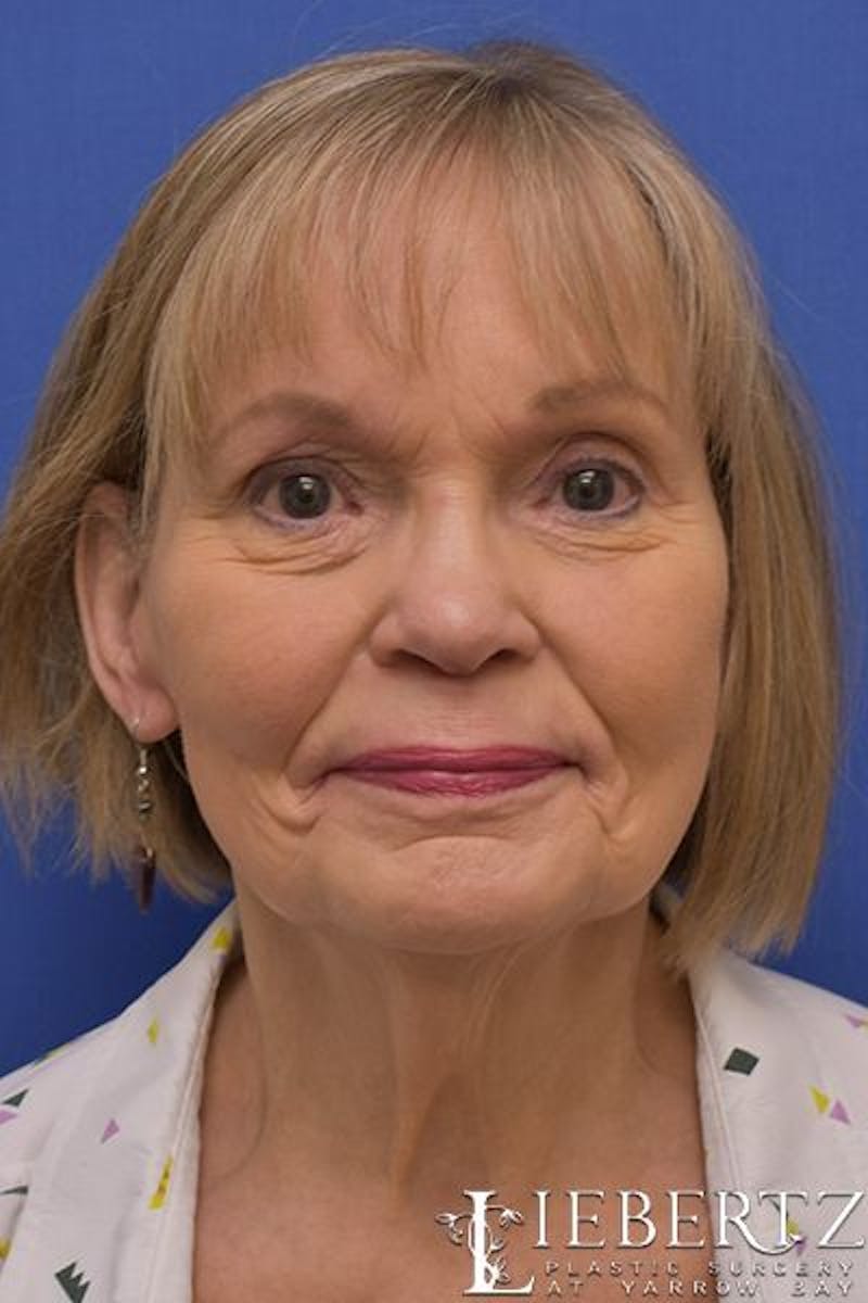 Facelift Before & After Gallery - Patient 411692 - Image 5