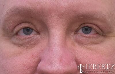 Blepharoplasty Before & After Gallery - Patient 411816 - Image 2