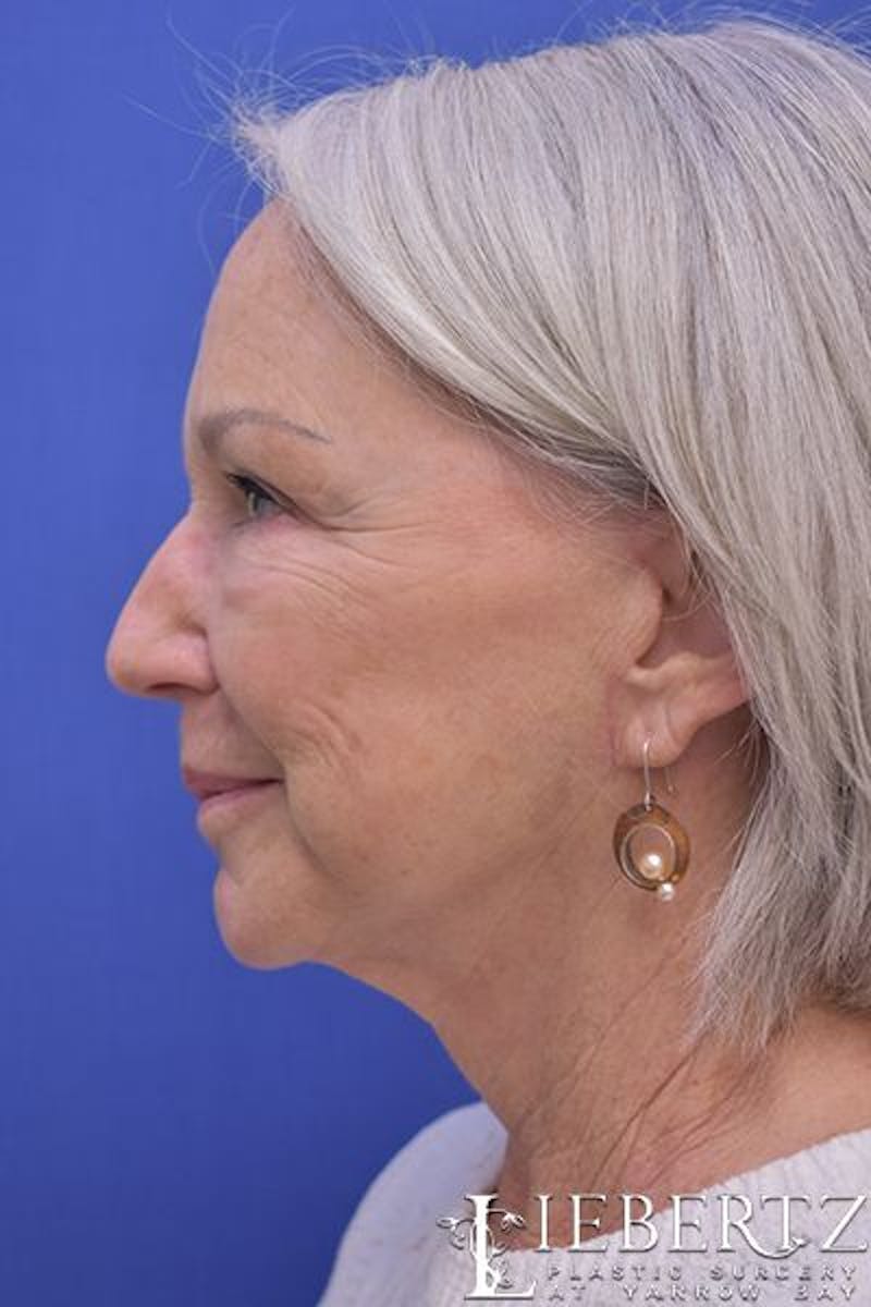 Necklift Before & After Gallery - Patient 344897 - Image 6