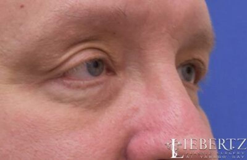 Blepharoplasty Before & After Gallery - Patient 411816 - Image 3