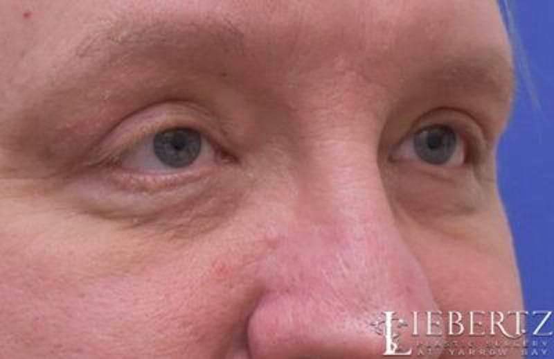 Blepharoplasty Before & After Gallery - Patient 411816 - Image 4