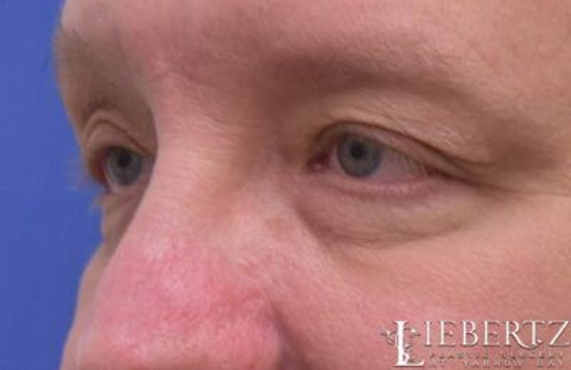 Blepharoplasty Before & After Gallery - Patient 411816 - Image 5