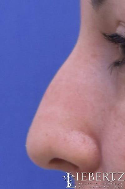 Rhinoplasty Before & After Gallery - Patient 160277 - Image 1