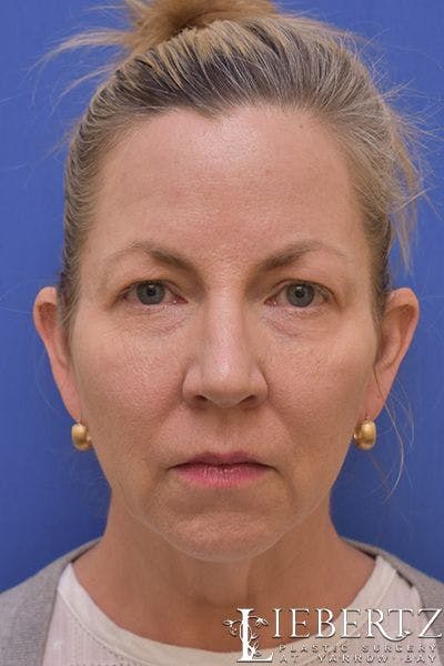 Facelift Before & After Gallery - Patient 363671 - Image 1