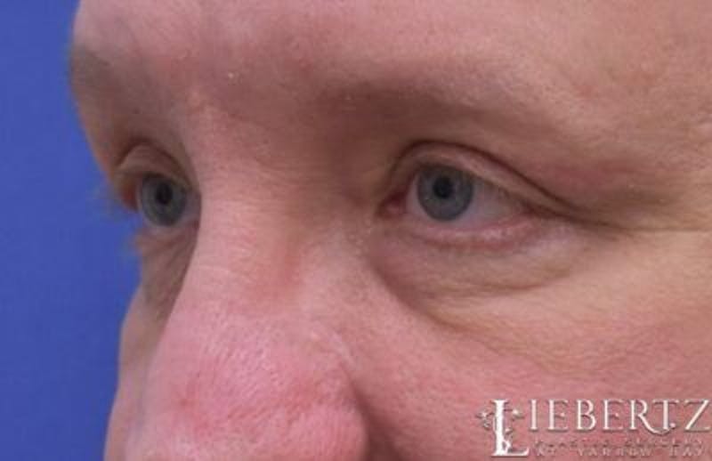 Blepharoplasty Before & After Gallery - Patient 411816 - Image 6