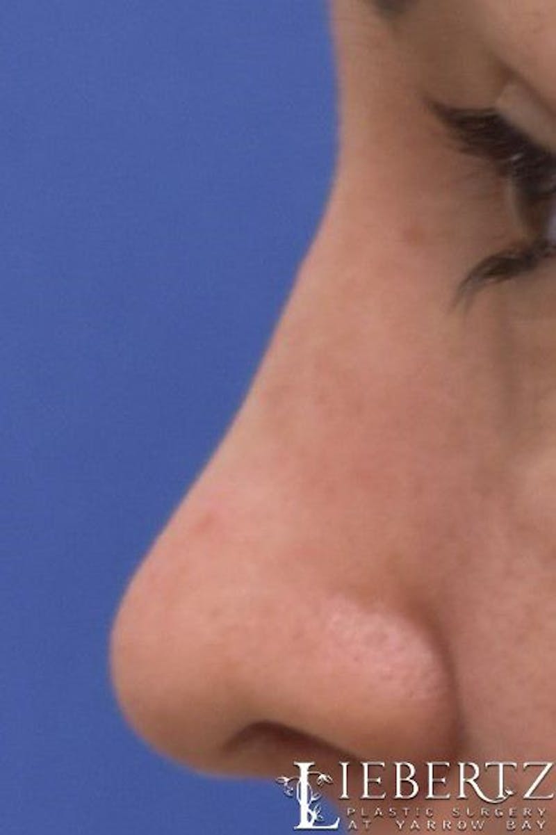 Rhinoplasty Before & After Gallery - Patient 160277 - Image 2