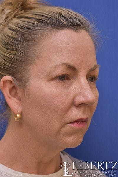 Facelift Before & After Gallery - Patient 363671 - Image 1