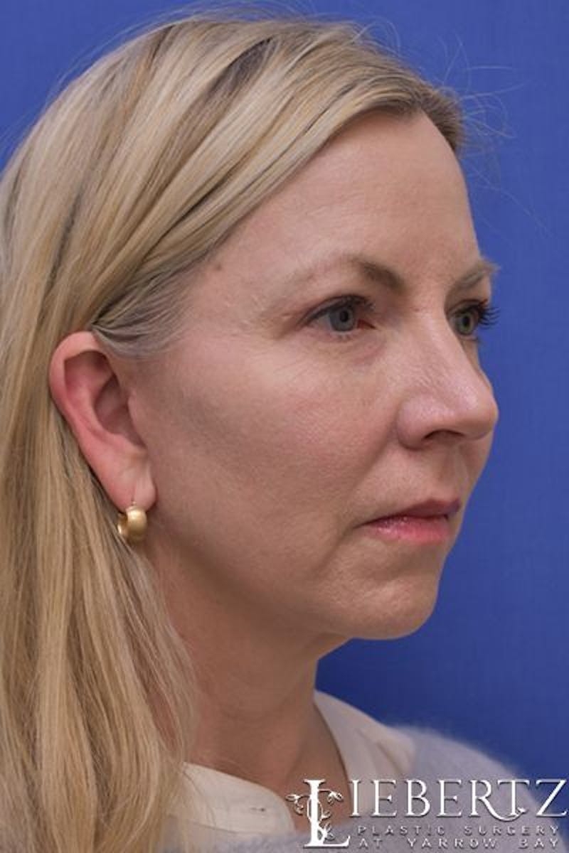 Facelift Before & After Gallery - Patient 363671 - Image 4