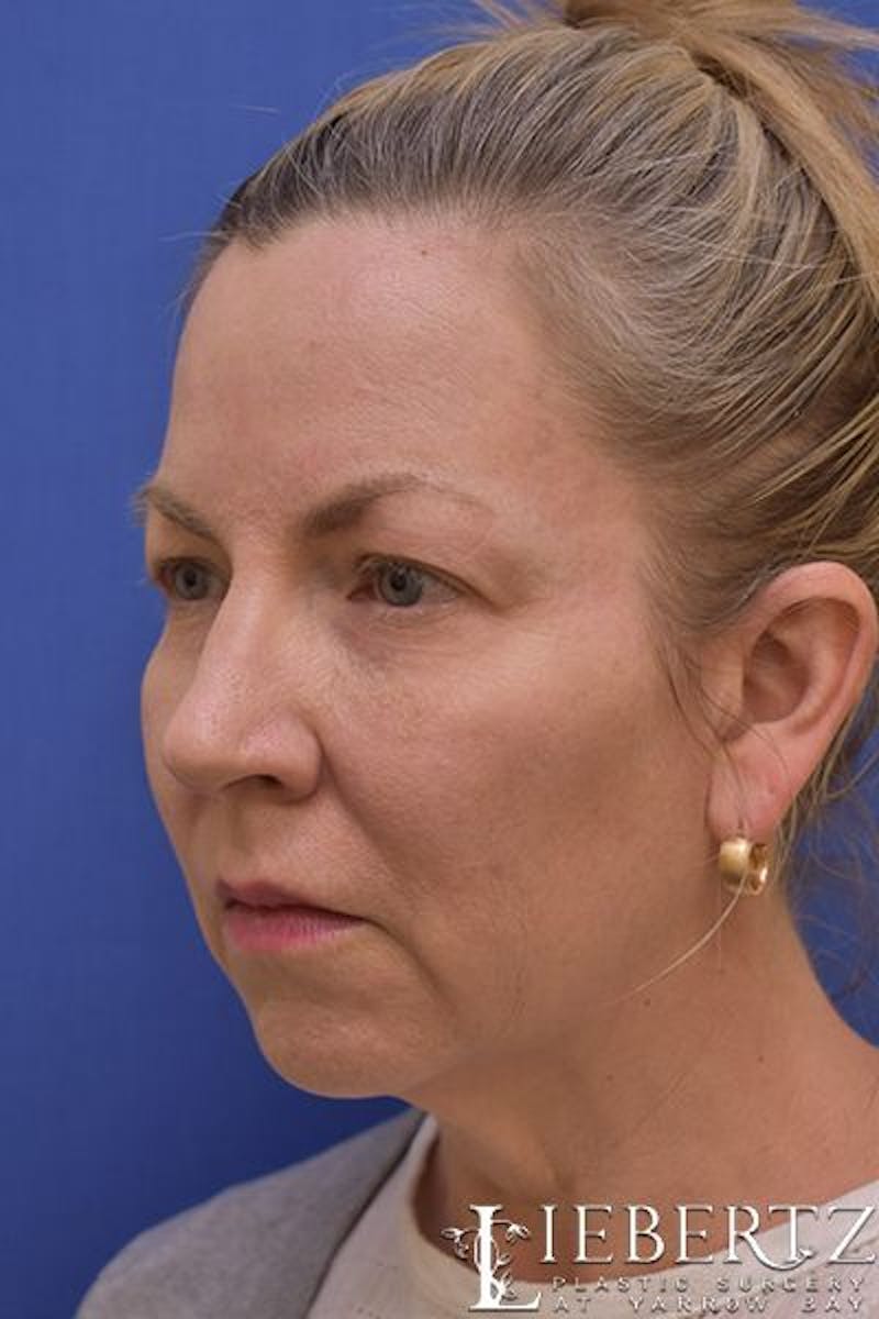 Facelift Before & After Gallery - Patient 363671 - Image 5