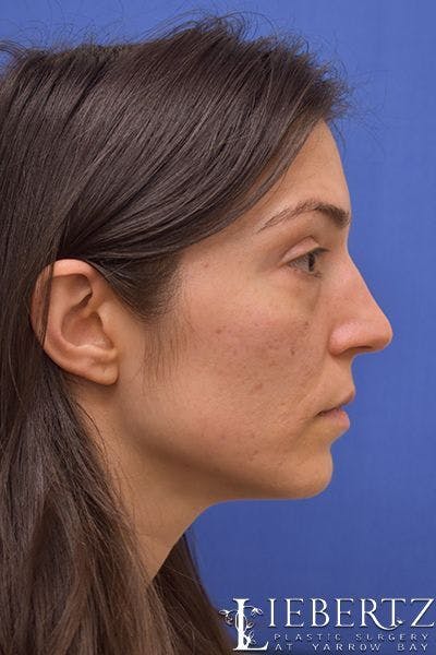 Rhinoplasty Before & After Gallery - Patient 267070 - Image 1