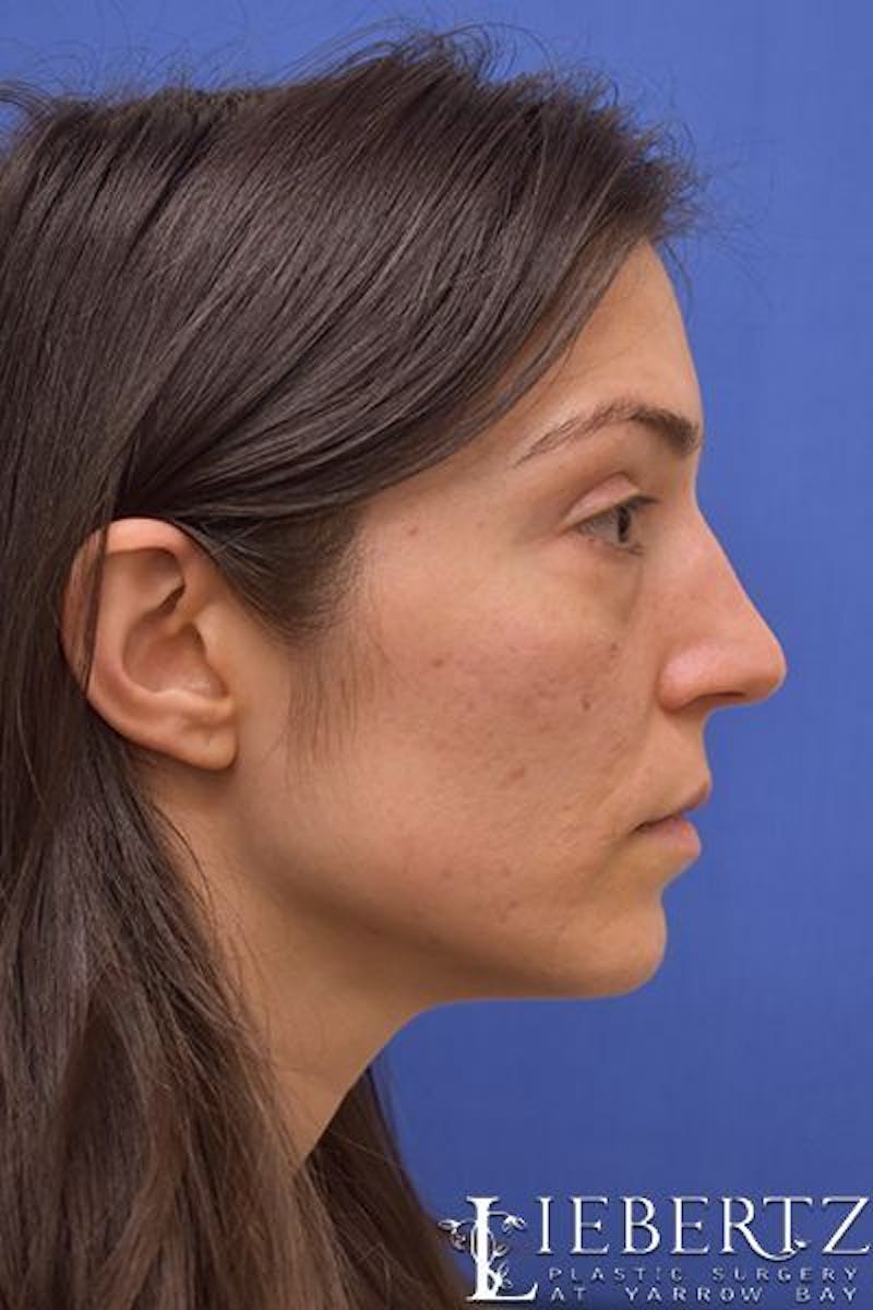 Rhinoplasty Before & After Gallery - Patient 267070 - Image 5