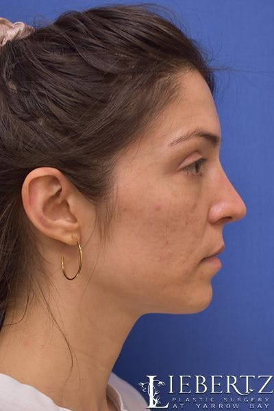 Rhinoplasty Before & After Gallery - Patient 267070 - Image 2