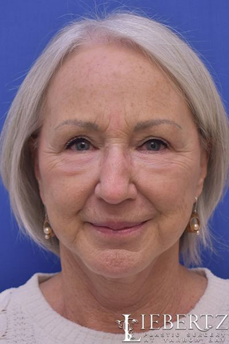 Facelift Before & After Gallery - Patient 366224 - Image 2