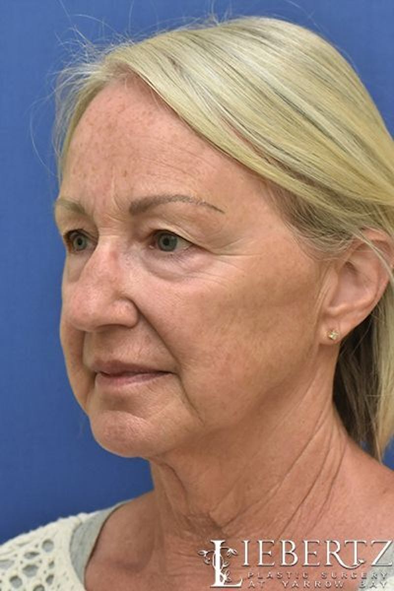 Facelift Before & After Gallery - Patient 366224 - Image 3