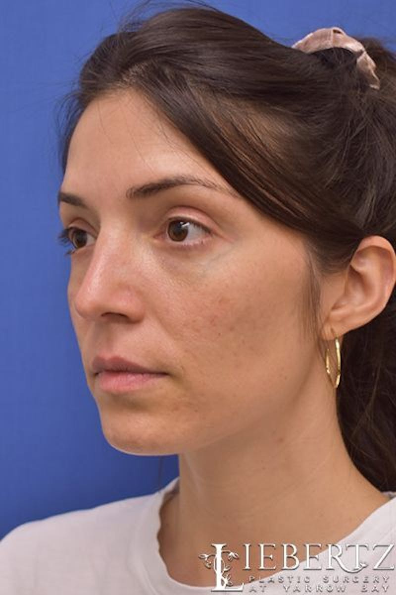 Rhinoplasty Before & After Gallery - Patient 267070 - Image 8