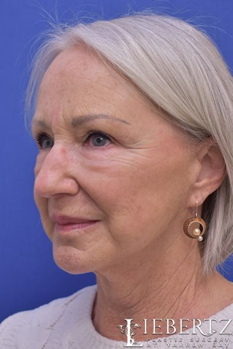Facelift Before & After Gallery - Patient 366224 - Image 4