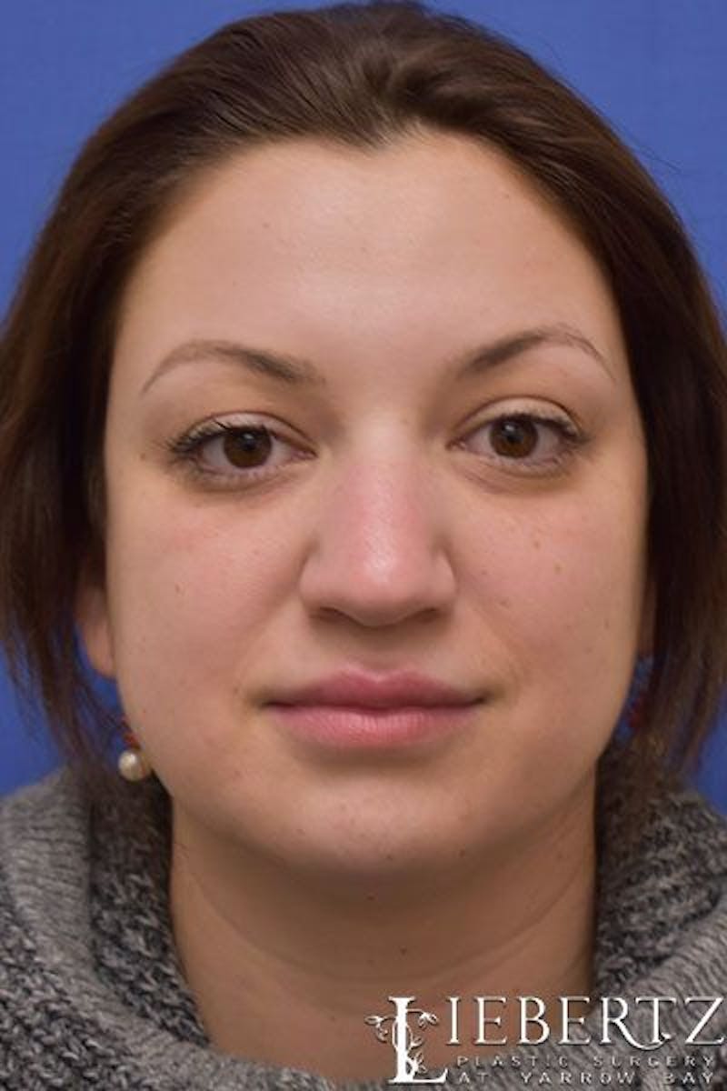 Rhinoplasty Before & After Gallery - Patient 149145 - Image 1