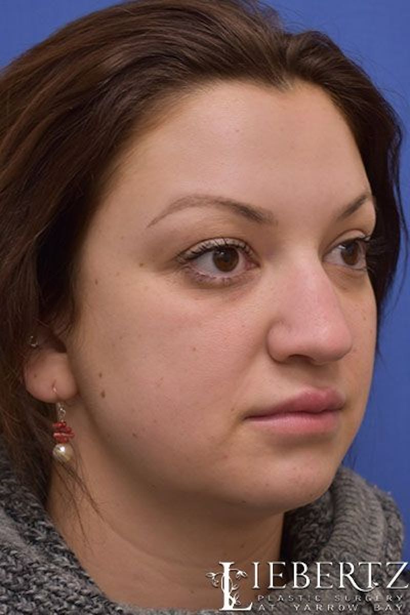 Rhinoplasty Before & After Gallery - Patient 149145 - Image 5