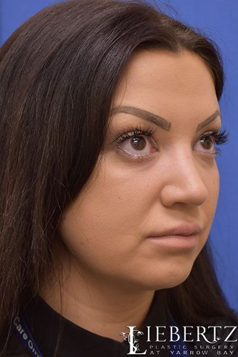Rhinoplasty Before & After Gallery - Patient 149145 - Image 6
