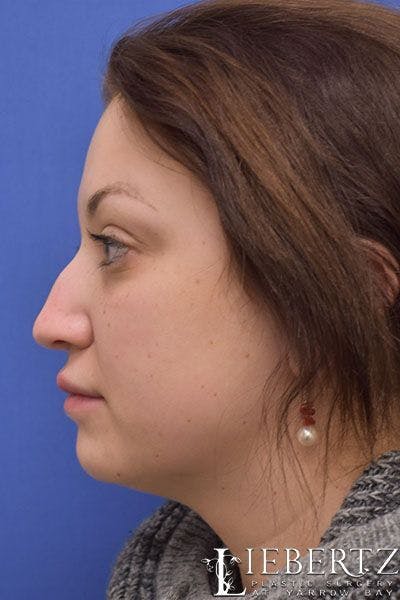 Rhinoplasty Before & After Gallery - Patient 149145 - Image 1