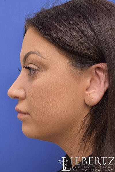 Rhinoplasty Before & After Gallery - Patient 149145 - Image 2