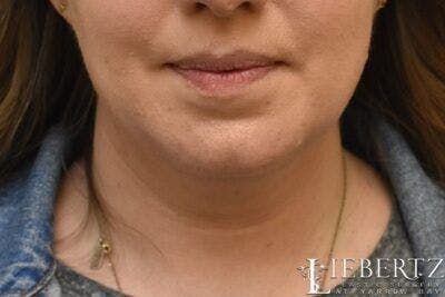 Submental Liposuction Before & After Gallery - Patient 138593 - Image 1