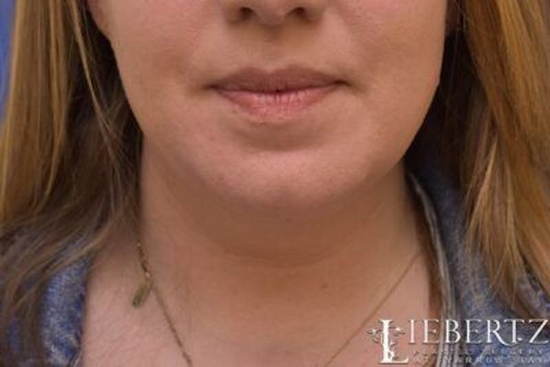 Submental Liposuction Before & After Gallery - Patient 138593 - Image 2