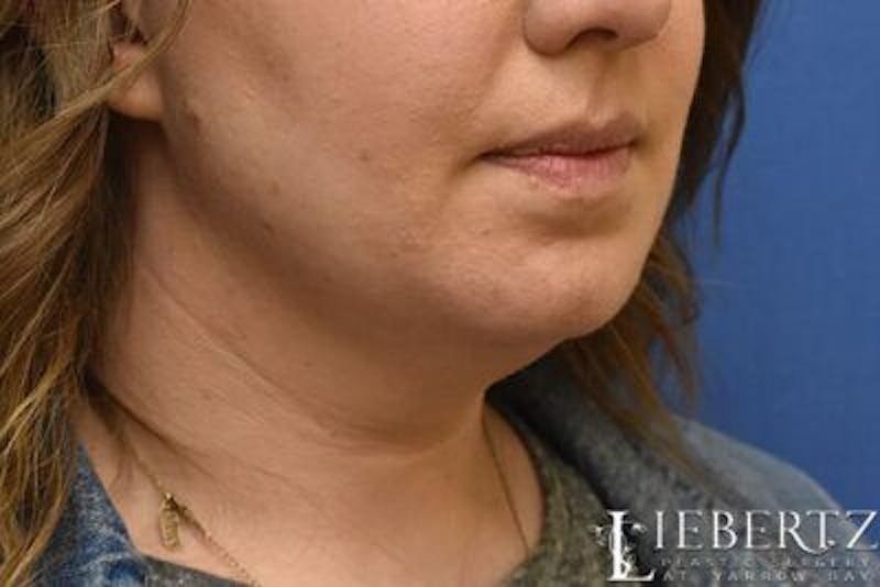 Submental Liposuction Before & After Gallery - Patient 138593 - Image 7