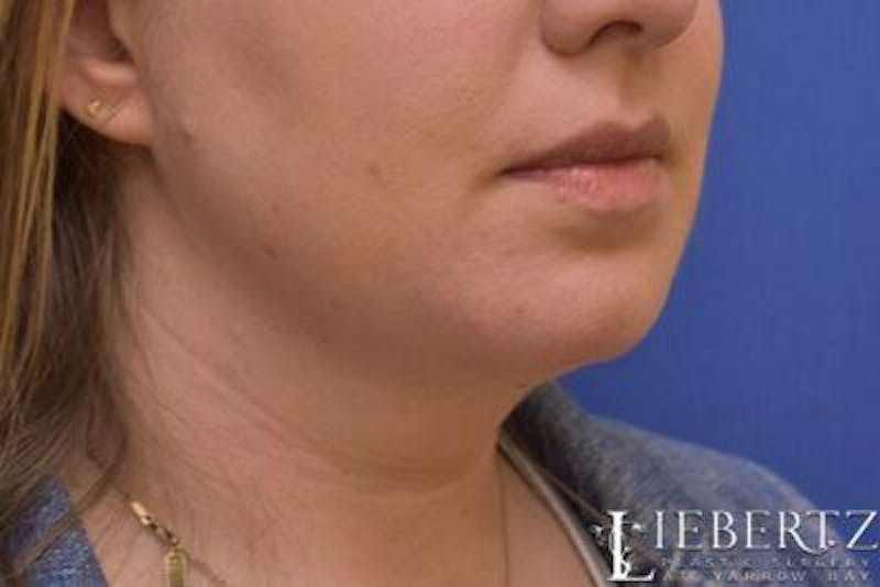 Submental Liposuction Before & After Gallery - Patient 138593 - Image 8